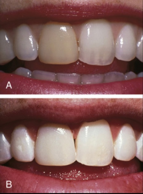 Dental Veneers