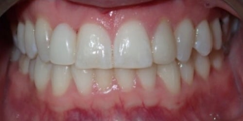 After Implants