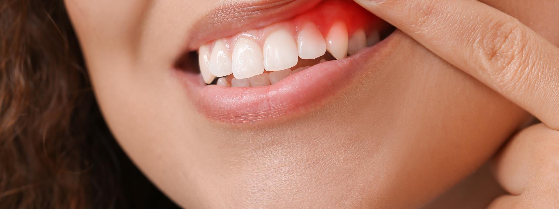 Gingivitis 101: Understanding the Basics of Gum Inflammation