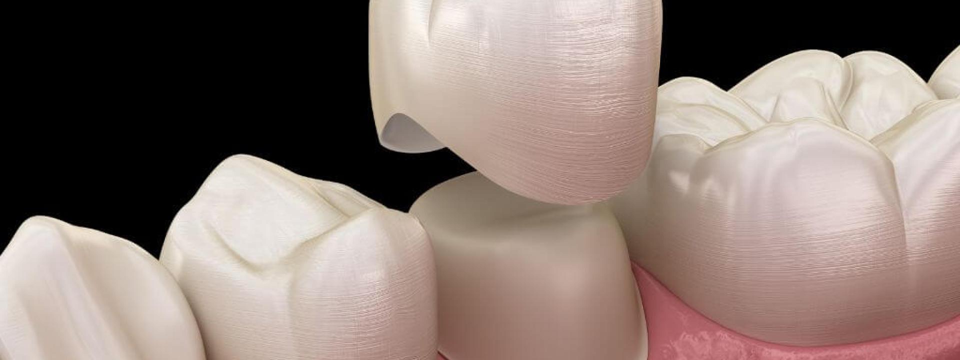 Right Material for Your Smile Right Material for Your Smile